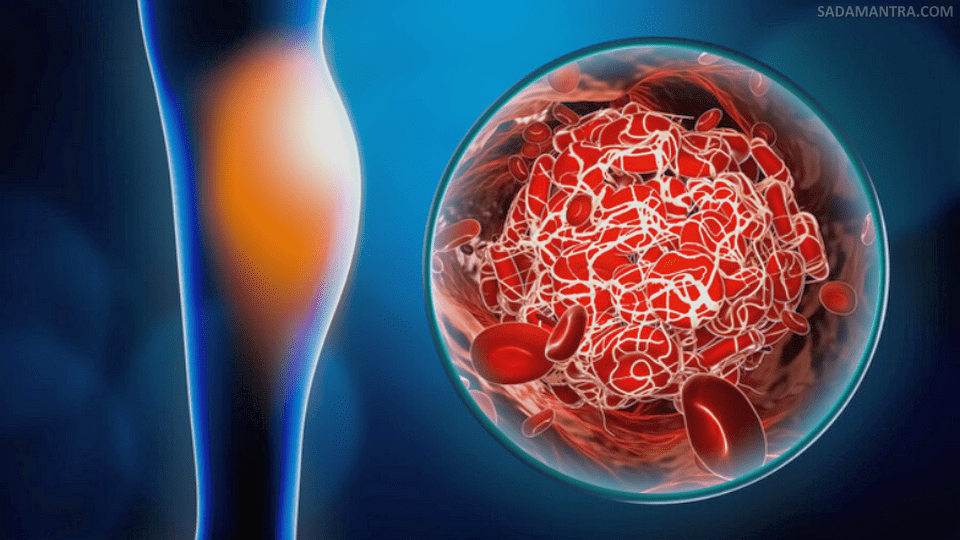 apa yang menyebabkan terjadi pembekuan darah?