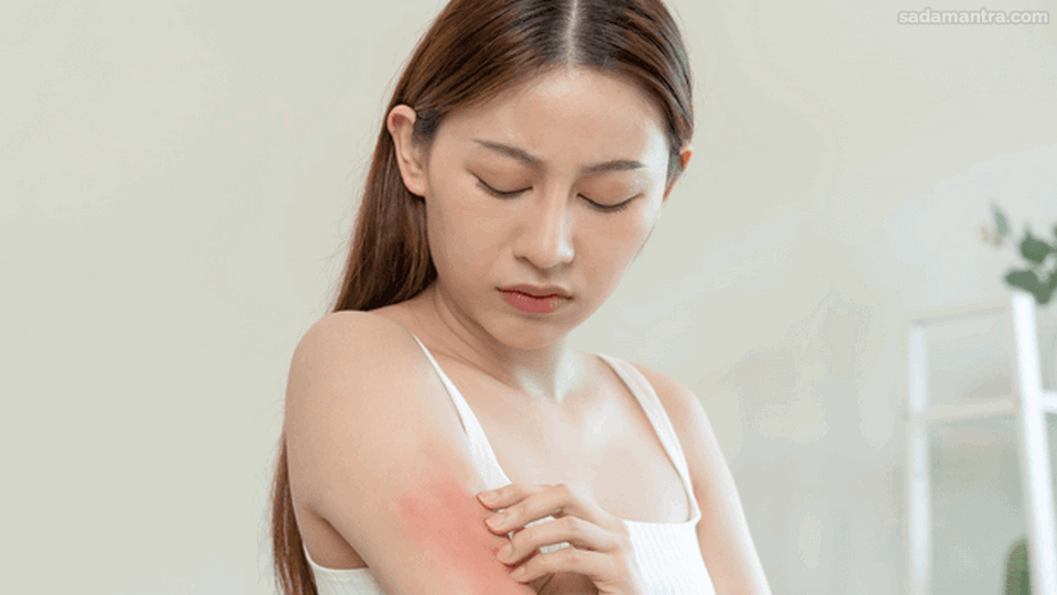 Manfaat Olahraga Bisa Membantu Penyembuhan Eksim