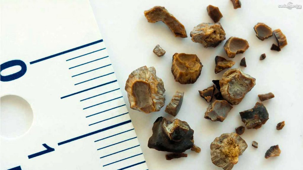 Waspadai Lewat Urine: 8 Sinyal Tubuh Sedang Menyimpan Batu Ginjal Waspadai lewat urine 8 sinyal tubuh sedang menyimpan batu ginjal